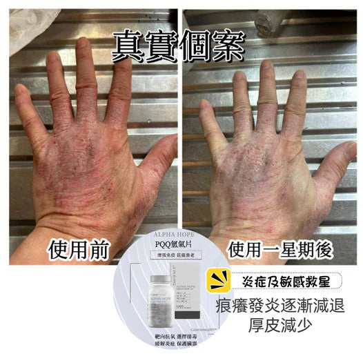 真實個案 - 一星期後痕癢發炎減退，厚皮減少，逐漸康復