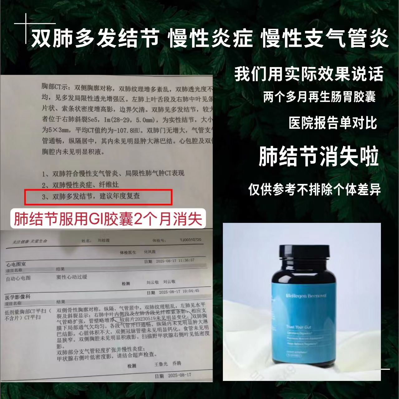 LifeRegen Beenovel G1 再生腸胃膠囊見證截圖，展示產品藍色瓶身與雙肺多發結節改善的醫院 CT 胸部檢查報告對比。